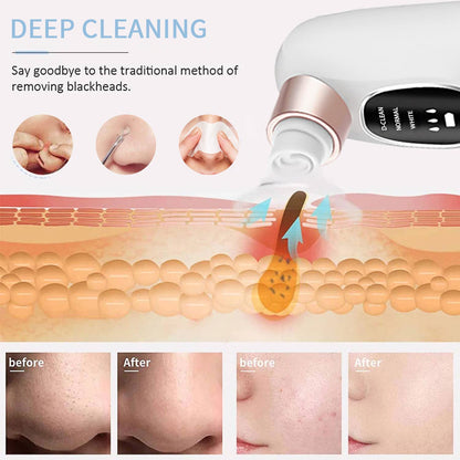 Azra Aqua Vacuum Pore Cleaner | Blackhead Remover