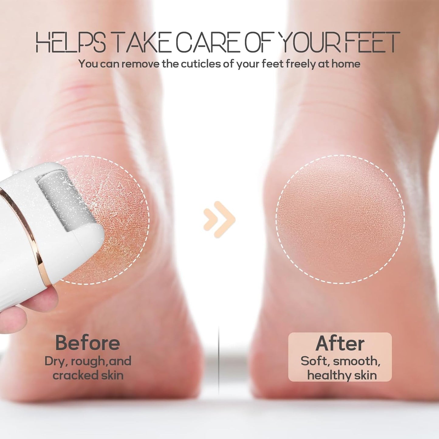 Babyverse Automatic Foot Callus Remover – Rechargeable, Waterproof, 3 Heads